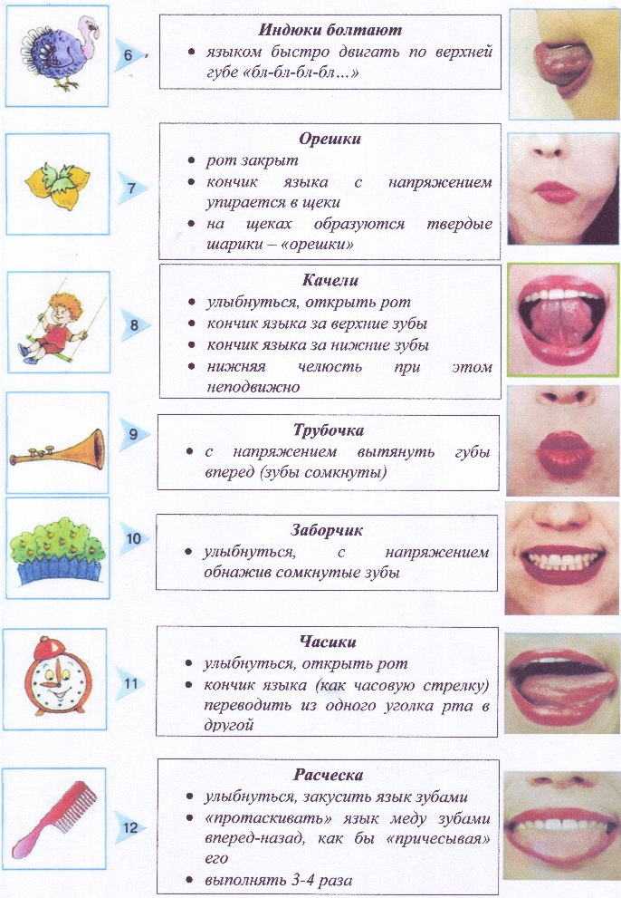 Дизартрия