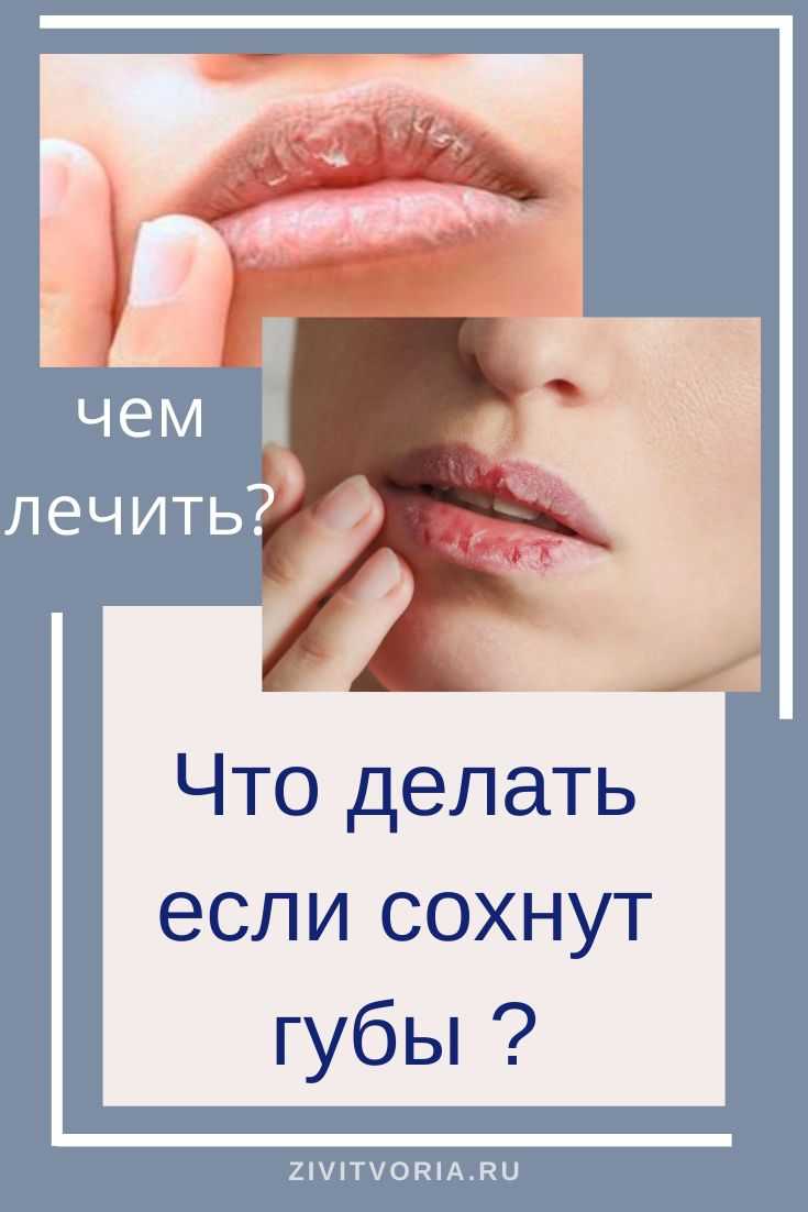 У ребенка сильно шелушатся губы. почему у ребенка сохнут и трескаются губы — определяем причину. провоцирующие факторы и диагностика