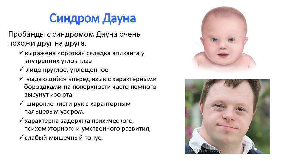 Умственная отсталость при синдроме дауна