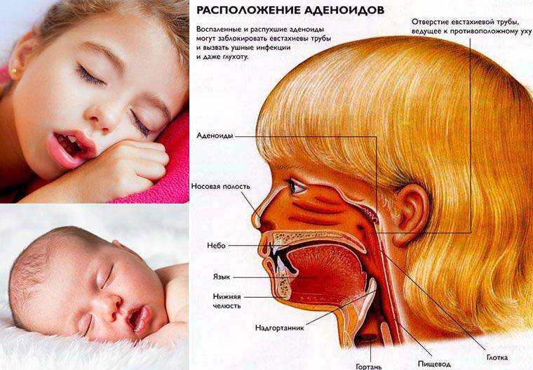 Ребенок храпит ночью: причины, возможные осложнения, лечение.