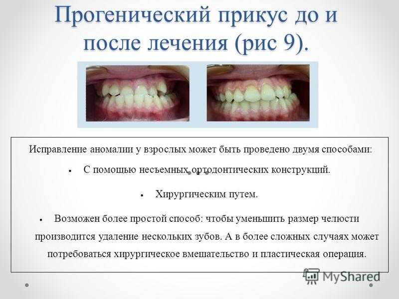 Неправильный прикус у ребенка: способы исправления - ваш ортодонт