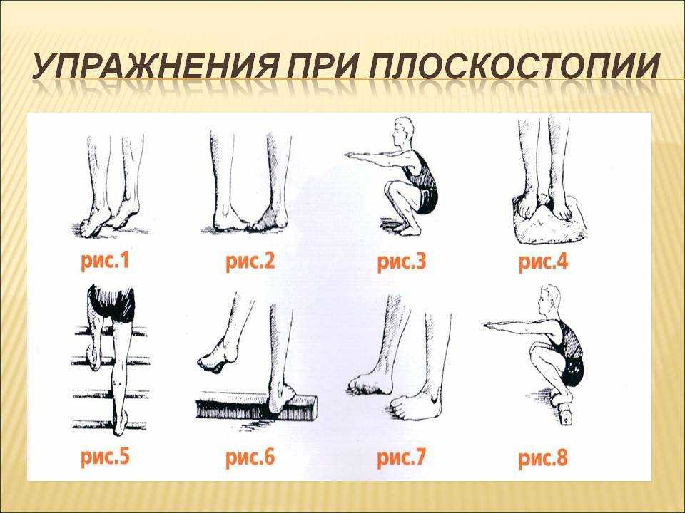 Лфк при плоскостопии у детей - комплекс упражнений, лечебная гимнастика для стоп