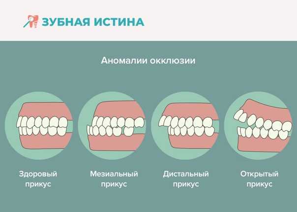 Неправильный прикус у ребенка: причины и как проверить детский прикус зубов - брекеты это модно