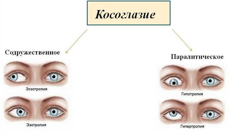 Косоглазие у новорожденных: причины, профилактика, лечение