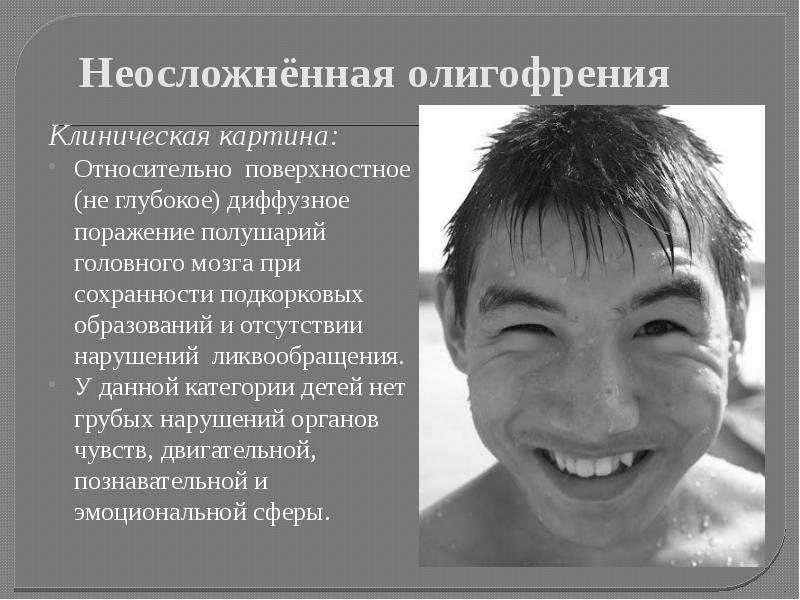 Синдром дауна