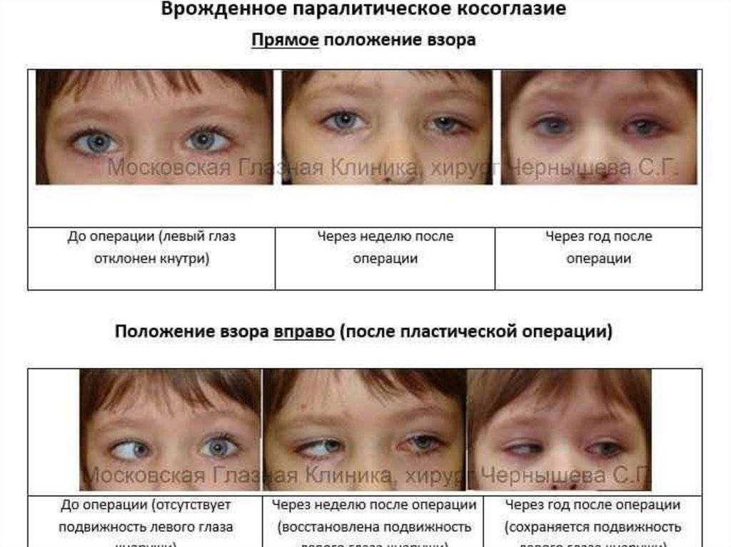 Косоглазие у новорожденных детей: причины, когда проходит, лечение
