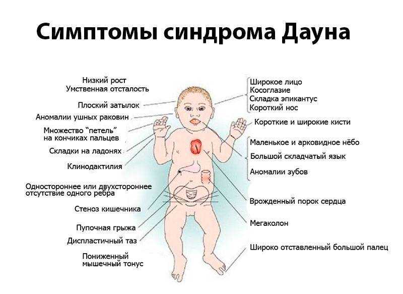Синдром дауна: мифы и факты – nakedheart.online