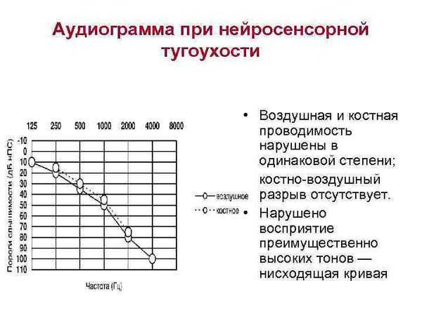 Какие бывают виды тугоухости и глухоты? | фонд «близкие другие»