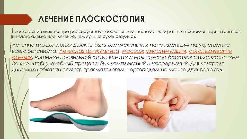 Плоскостопие у детей - чем опасно, симптомы, как лечить