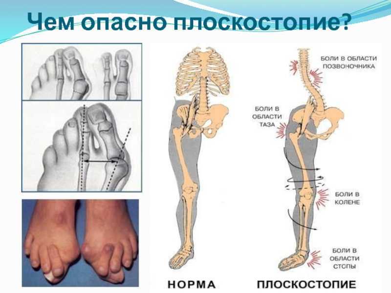 Плоскостопие у детей дошкольного возраста, как его определить (признаки + фото)