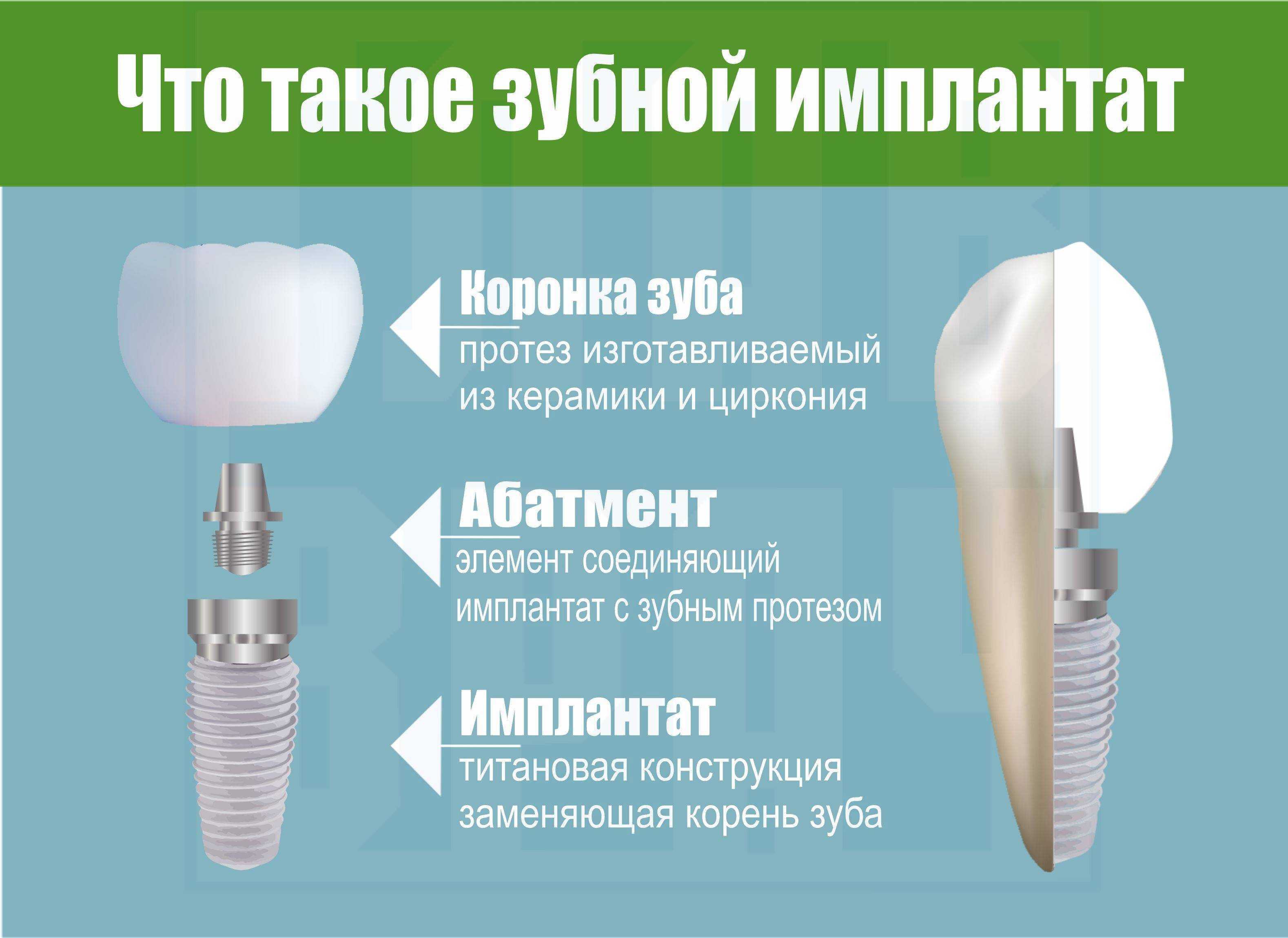 Статья о стоматологии: так ли вам нужны импланты, как вы думаете?