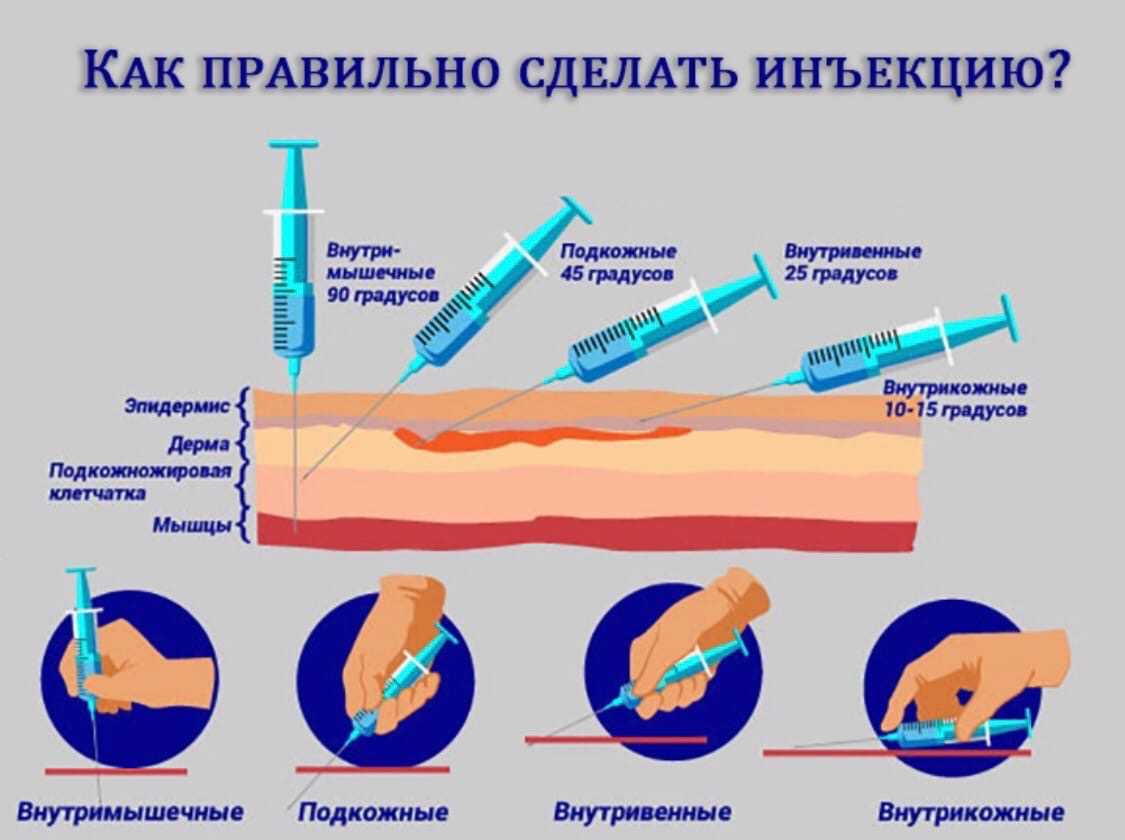 Иньекция или инъекция: как правильно пишется и что означают эти слова?
