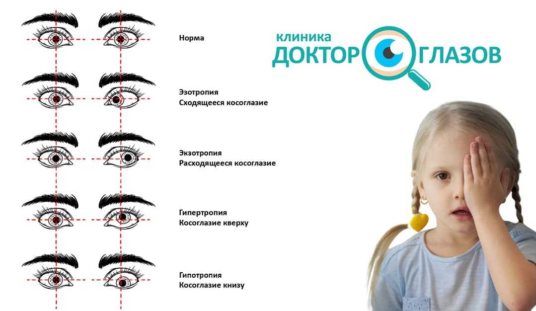 Почему бывает косоглазие у новорожденных - глаза и их заболевания