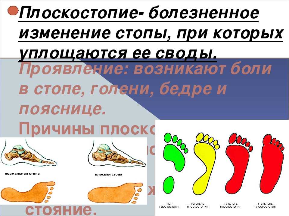 Лфк и массаж при плоскостопии, врожденной косолапости, кривошее | nmedik.org
