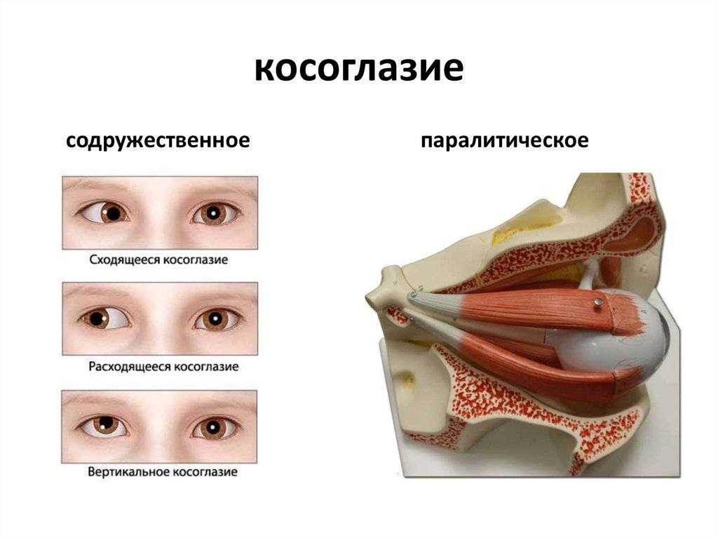 Косоглазие у детей - причины и лечение, виды и симптомы