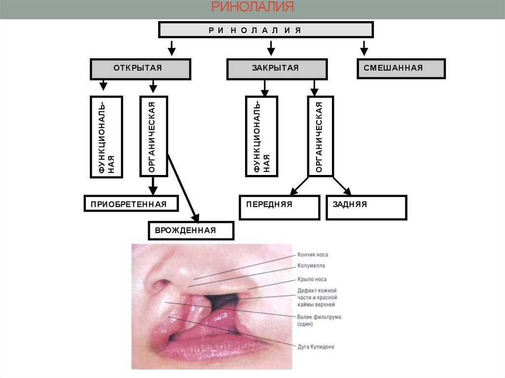 Ринолалия. причины, классификация, особенности коррекции | вся logoпедия