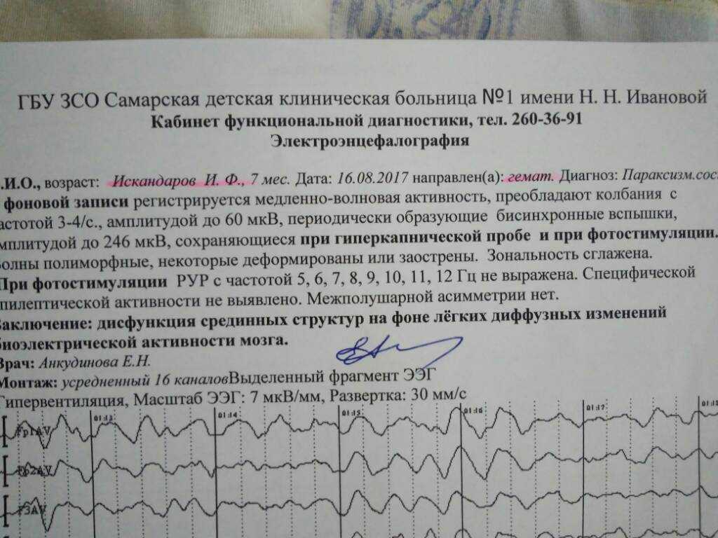 Что показывает ээг головного мозга у детей?