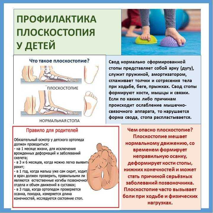 Плоскостопие у детей