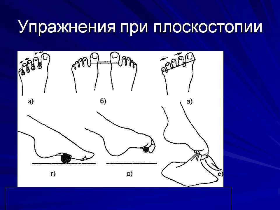 Упражнения при плоскостопии у детей дошкольного возраста: гимнастика для ног
