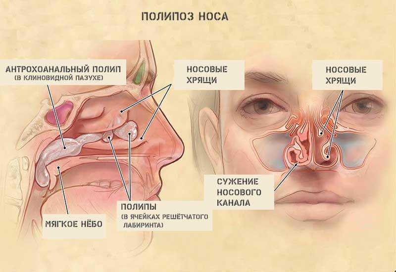 Ринолалия — киндер велт