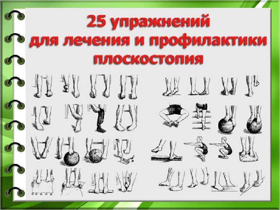 Лфк при плоскостопии у детей: упражнения для профилактики и устранения заболевания
