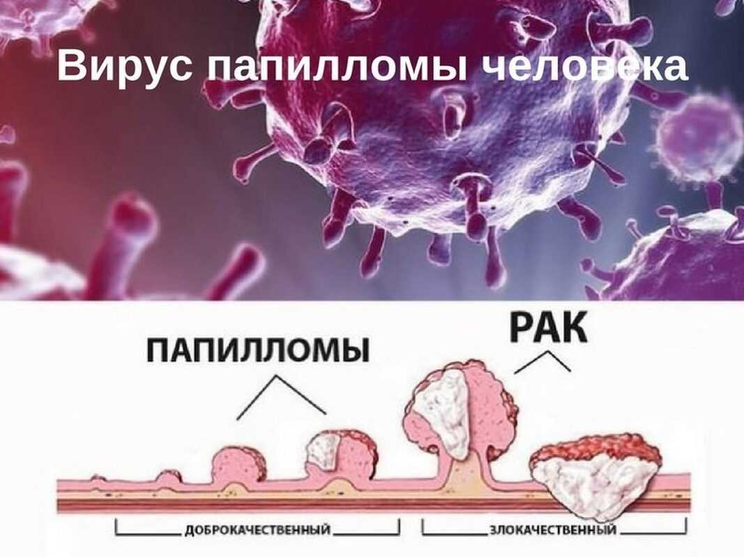 Делать или не делать прививку от вируса папилломы человека