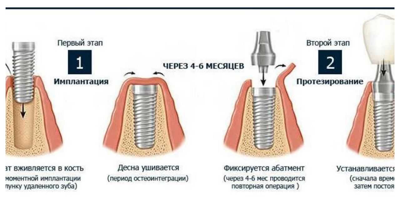 Этот медицинский термин встречается как минимум в трех обличьях: имплант, имплантант, имплантат Рассказываем, есть ли между ними различия и какой из вариантов самый правильный