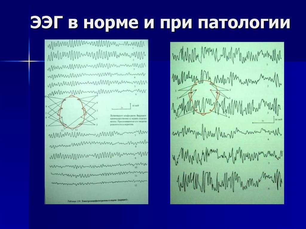 Нейролептики в лечении речевых и поведенческих нарушений у детей — клиника детской неврологии и реабилитации — neurospectrum