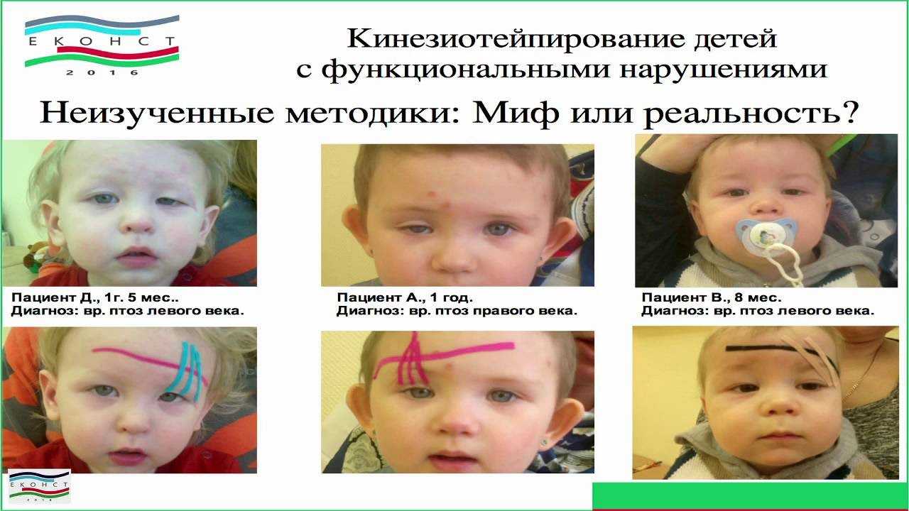 Логопедическое тейпирование детей: что такое тейпирование в логопедии