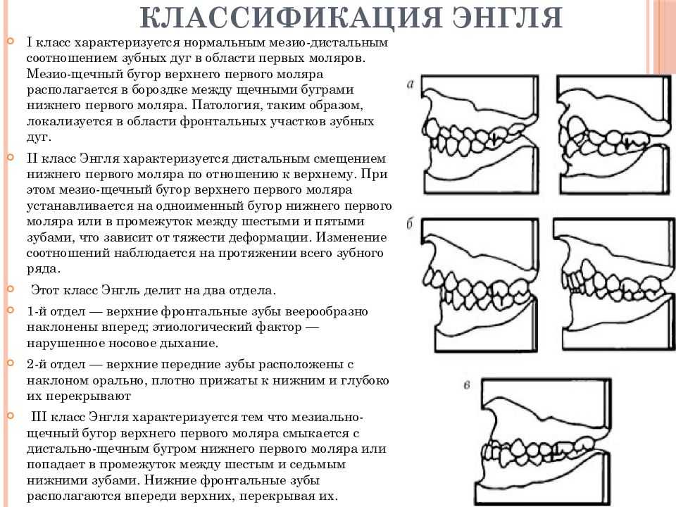 Верхняя челюсть выдвинута вперед: причины, последствия, методы лечения и профилактики