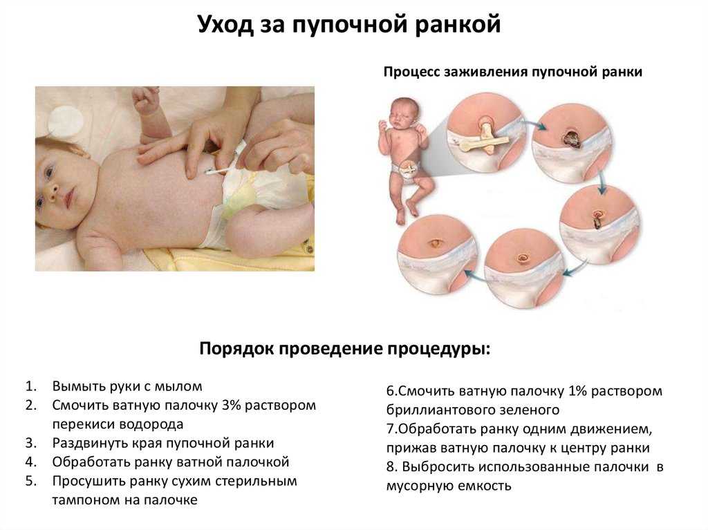 Обработка пупка новорожденного перекисью