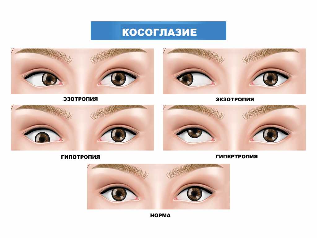 Косоглазие у новорожденных