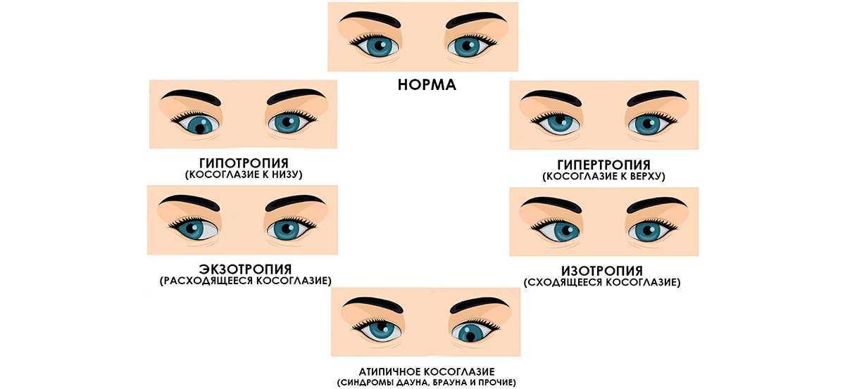 Косоглазие у новорожденных: почему косят глаза у грудничка?