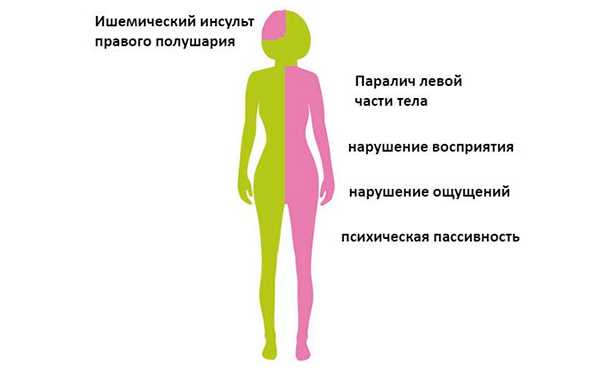 После установления диагноза перед началом восстановительной работы очень важно знать какое полушарие головного мозга у пациента доминантно