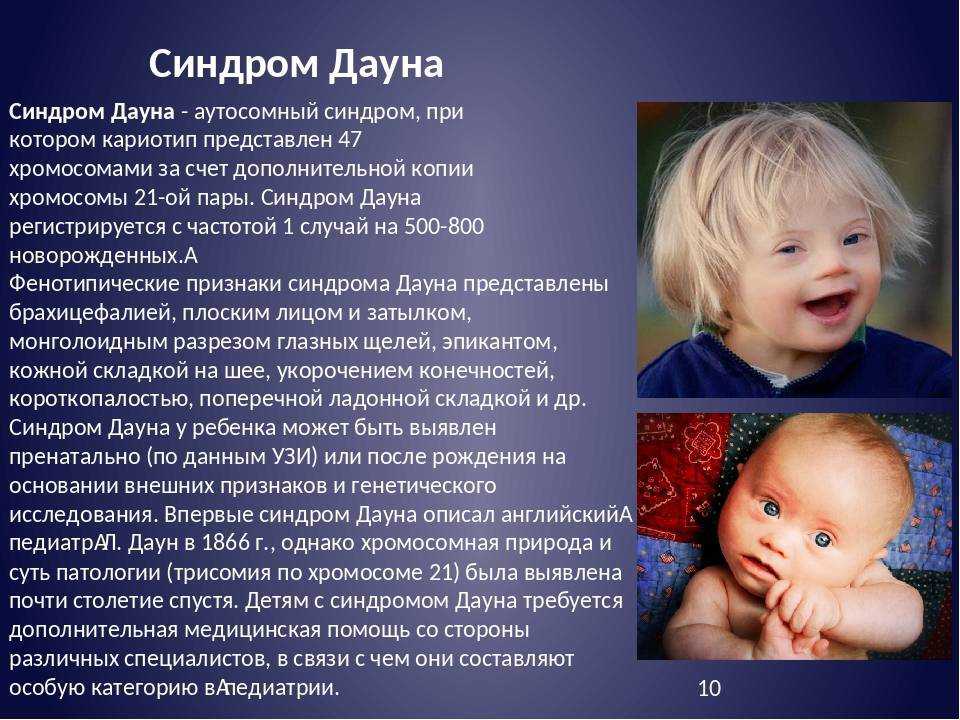 Синдром дауна у детей: симптомы, причины, лечение