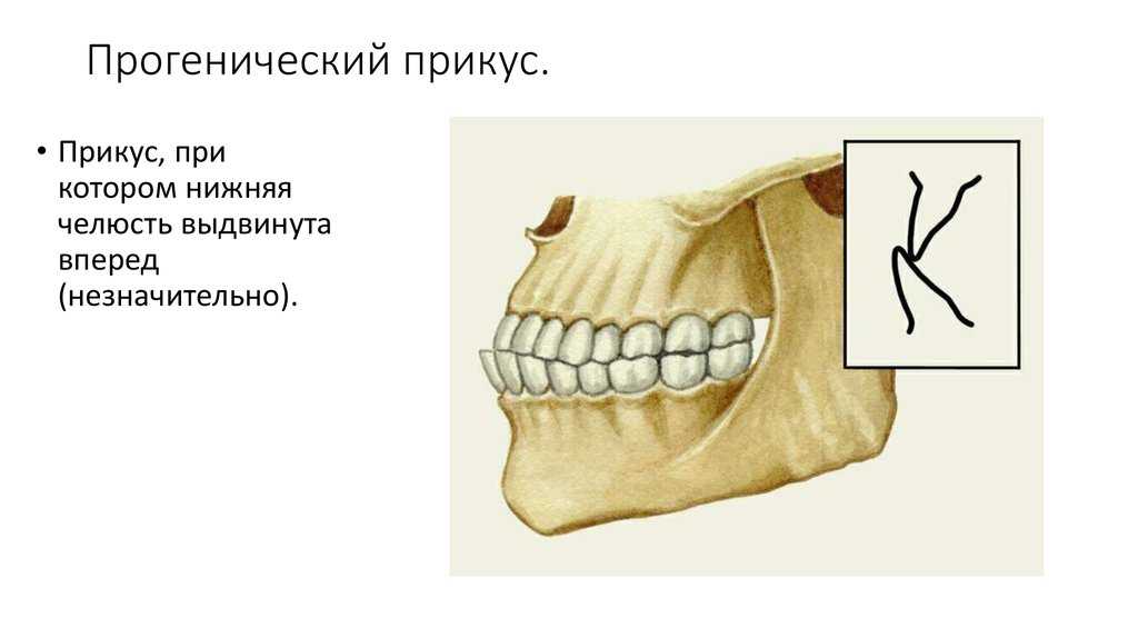 Исправление прикуса у взрослых: современные методы коррекции