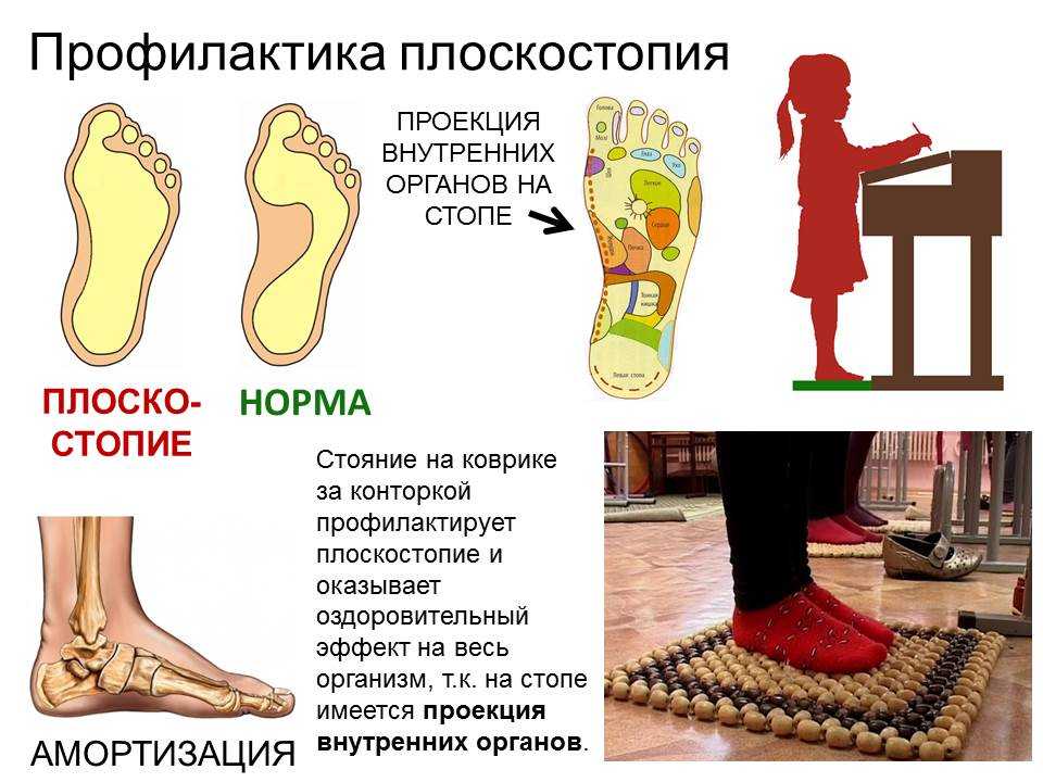 Лечение плоскостопия
