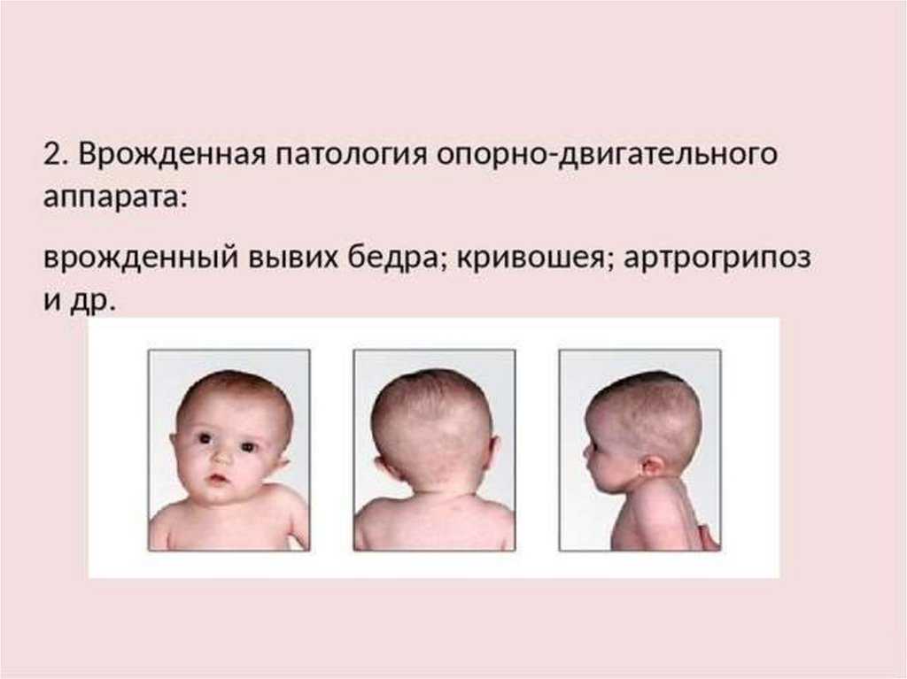 Синдром дауна