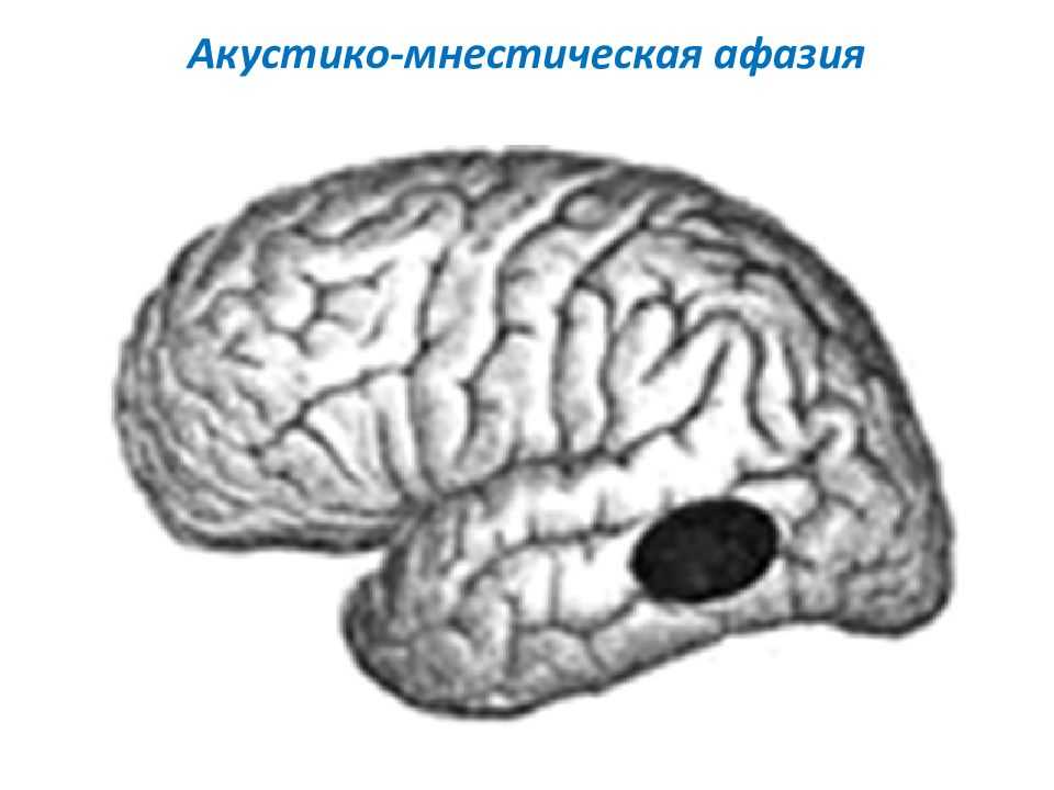 Акустико-гностическая афазия - медицинский справочник