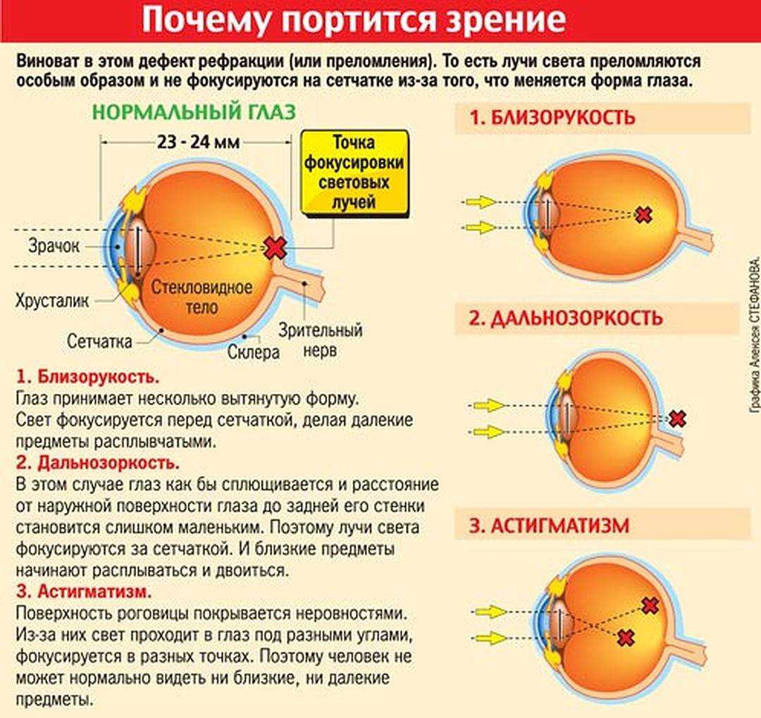 Миопия у детей: причины, лечение, профилактика