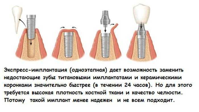 Рейтинг зубных имплантов