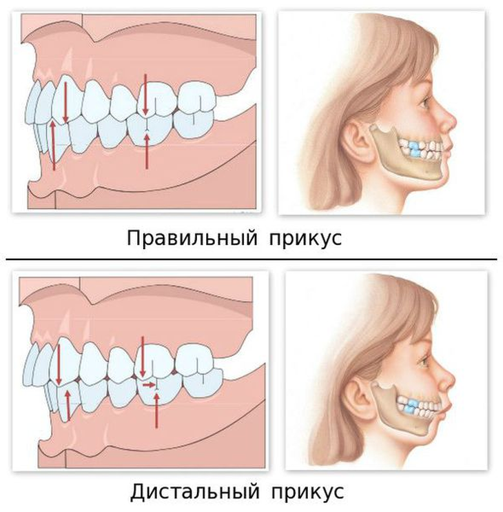Неправильный прикус у ребенка | профилактика и лечение прикуса