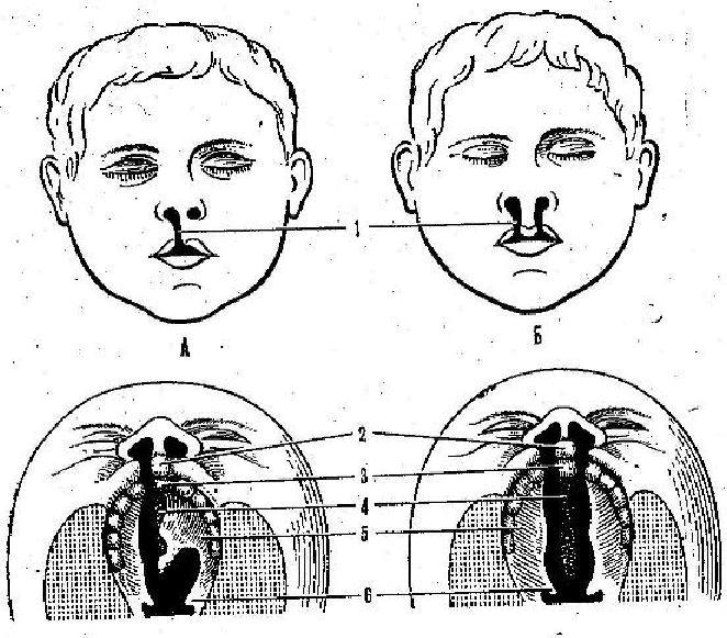 Ринолалия: закрытая, открытая и ее лечение