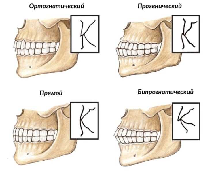 Какой прикус правильный?